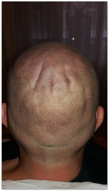 fejbőr mikropigmentáció